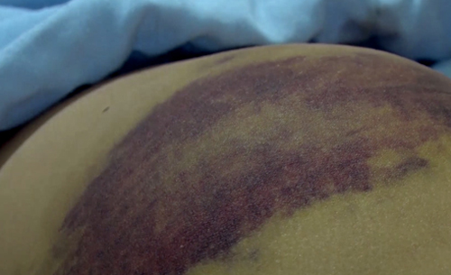 Hai bên mông của trẻ bị bạo hành bầm tím sau trận đòn roi