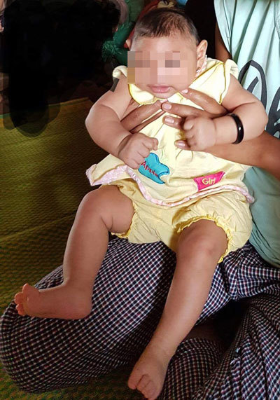 bé 4 tháng tuổi bị dị tật do zika
