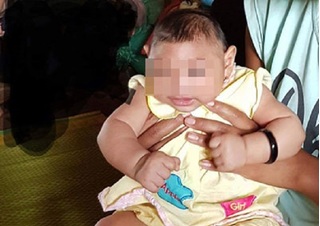 Bé gái 4 tháng tuổi ở Đắk Lắc bị dị tật đầu nhỏ do virus Zika