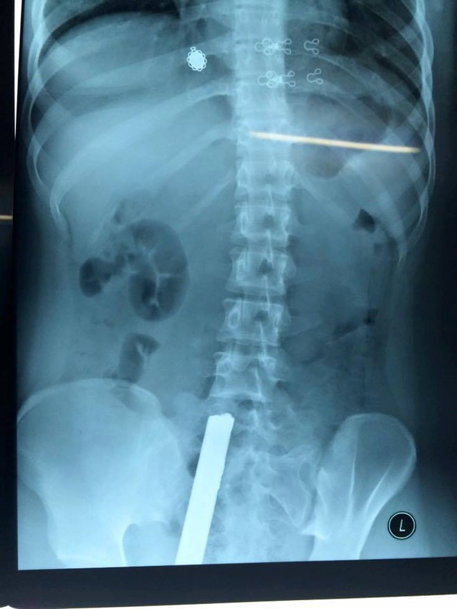 Hình ảnh chụp X quang cho thấy thanh sắt đâm xuyên người thiếu nữ sau tai nạn hy hữu