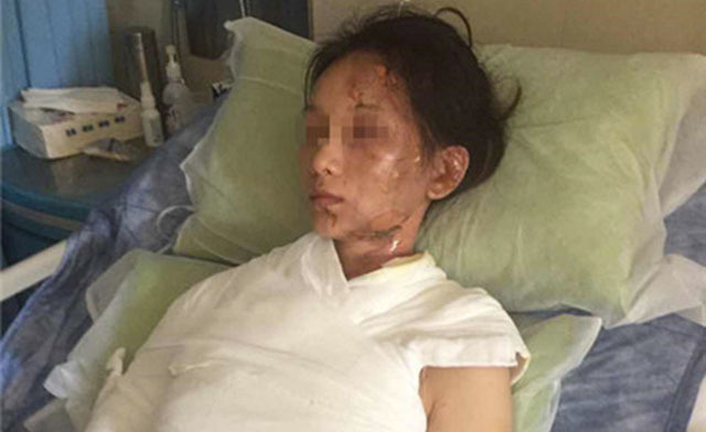 Cô gái Trung Quốc bị bỏng 42% thân thể vì nhân viên nhà hàng lẩu