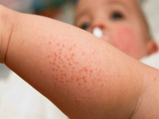 Hà Nội: Nhiều trẻ nhập viện vì sốt xuất huyết