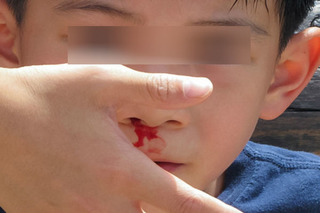 Bé trai 2 tuổi tử vong vì chảy máu cam: mẹ đau đớn khi phát hiện lý do
