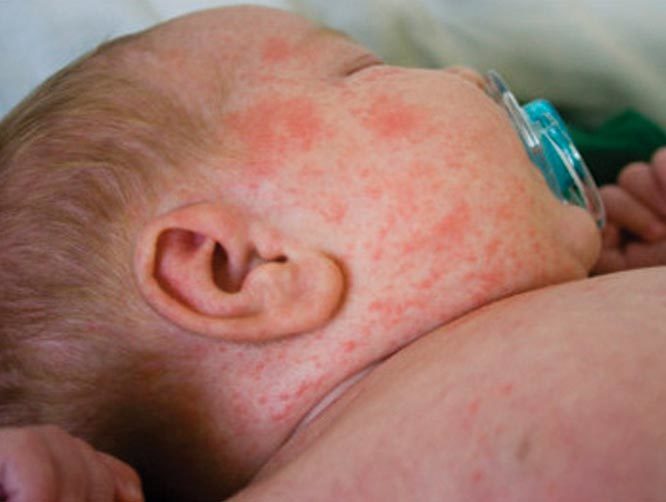 Khi bị bệnh sốt xuất huyết, trẻ rất có thể bị sốc gây nguy hiểm tính mạng