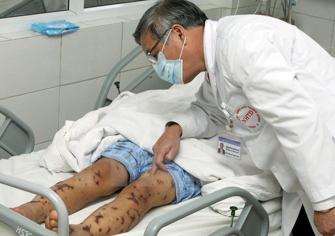 Hiện ổ dịch viêm não mô cầu ở Hà Nội đã được khống chế