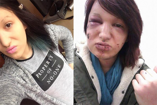 Melody trước và sau khi bị bạn trai cắn dã man