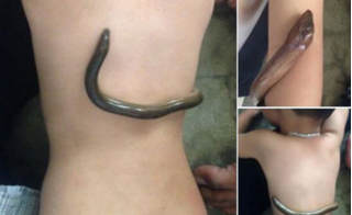 Dùng lươn sống lăn trên lưng hạ sốt cho trẻ: Bác sĩ nói gì?