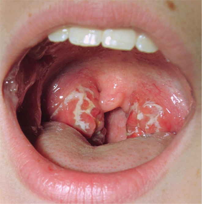 Dấu hiệu nhận biết ung thư vòm họng giai đoạn đầu rất ít người để ý