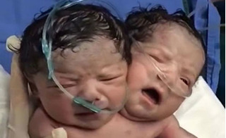 Xót xa bé sơ sinh hai đầu mang ống thở khóc to trên tay y tá