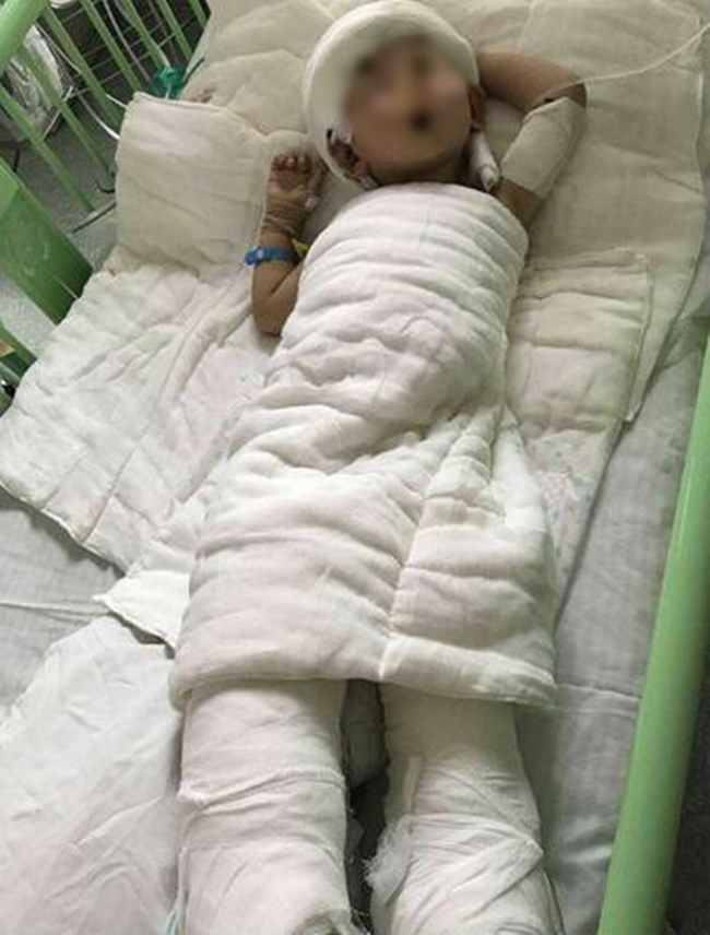 Tiểu Tuấn đang điều trị bỏng tại bệnh viện. Ảnh: ifeng