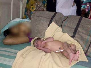 Mẹ sốc nặng nhìn con mới sinh có cả bộ phận sinh dục nam và nữ 