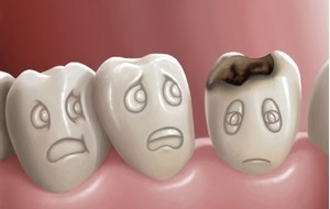 Thiếu Fluoride khiến răng dễ bị tổn thương hơn