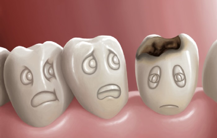 thiếu Fluoride dễ bị mắc bệnh sâu răng