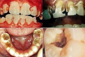 Thuốc lá không tốt cho răng miệng của bạn