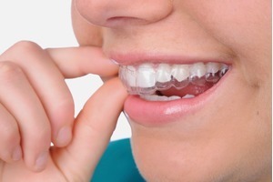 Làm thế nào để duy trì màu răng sau tẩy trắng?