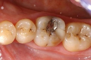 Bệnh sâu răng và những điều bạn cần biết
