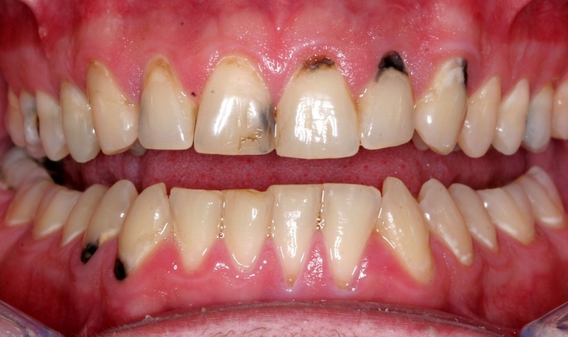 Bệnh sâu răng