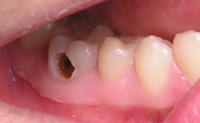 Điều trị bệnh sâu răng 