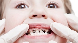 Răng sữa bị sâu có cần chữa trị?