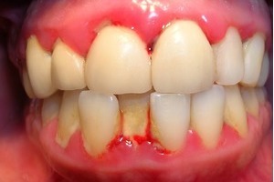 Nguyên nhân gây bệnh viêm răng cấp tính