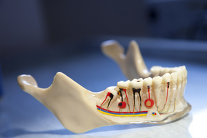 Bệnh viêm chân răng mạn tính và các biến chứng của nó