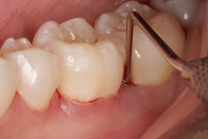 Nếu bị bệnh viêm quanh răng bạn cần chữa trị nhanh nhất có thể