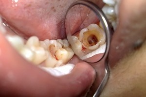 Các nguyên nhân gây viêm tủy răng cấp tính