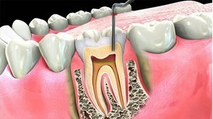Một số nguyên nhân gây viêm tủy răng cấp tính