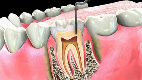 nguyên nhân gây viêm tủy răng cấp tính