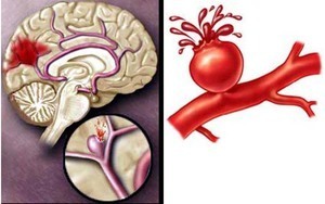 Não xuất huyết và não xơ cứng có gì khác biệt?