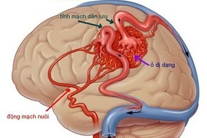 Tĩnh mạch não bị biến dạng là việc như thế nào?