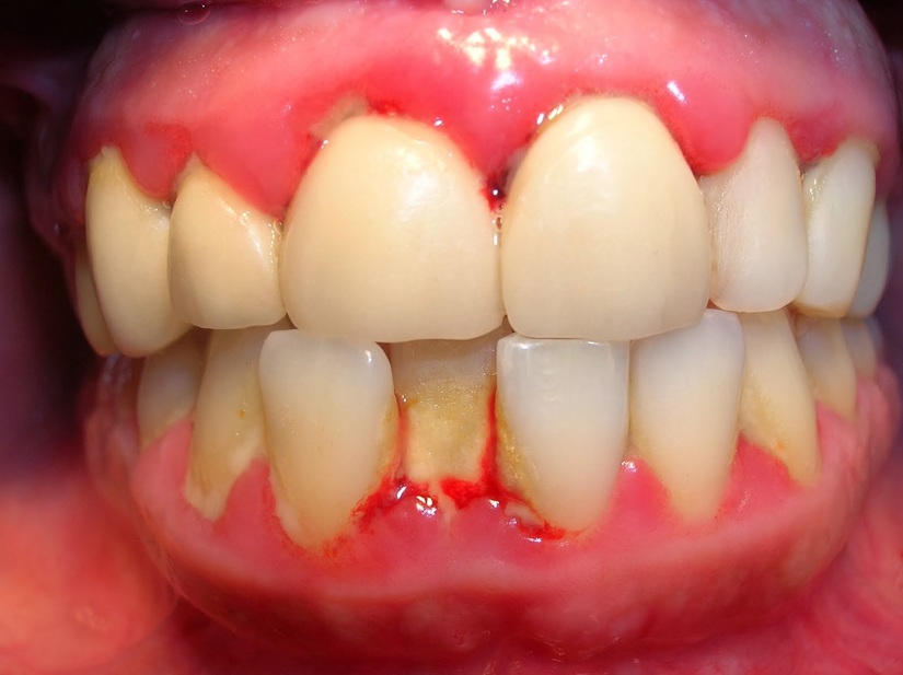 Bệnh viêm nhiễm nướu răng