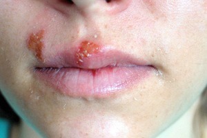 Nguyên nhân, triệu chứng và cách điều trị bệnh lở loét miệng