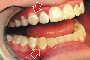 Răng bị ố do Fluor - triệu chứng men răng bị ố vàng