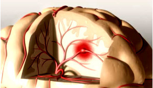 Nghẽn mạch ở tĩnh mạch sâu điều trị như thế nào?