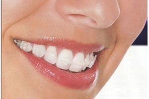 Răng bằng sứ là gì và nó thích hợp đối với những loại răng nào