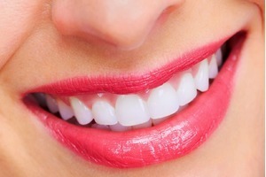 Tẩy trắng răng sẽ giữ được bao lâu và cách duy trì màu răng sau tẩy trắng