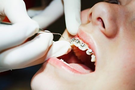 Điều trị chỉnh hình răng mặt 