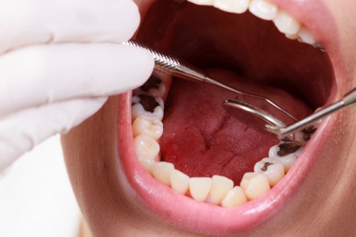 Để phòng tránh bệnh sâu răng hiệu quả