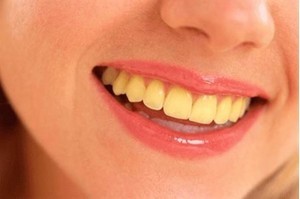 Nguyên nhân gây ra sậm màu ở răng vĩnh viễn
