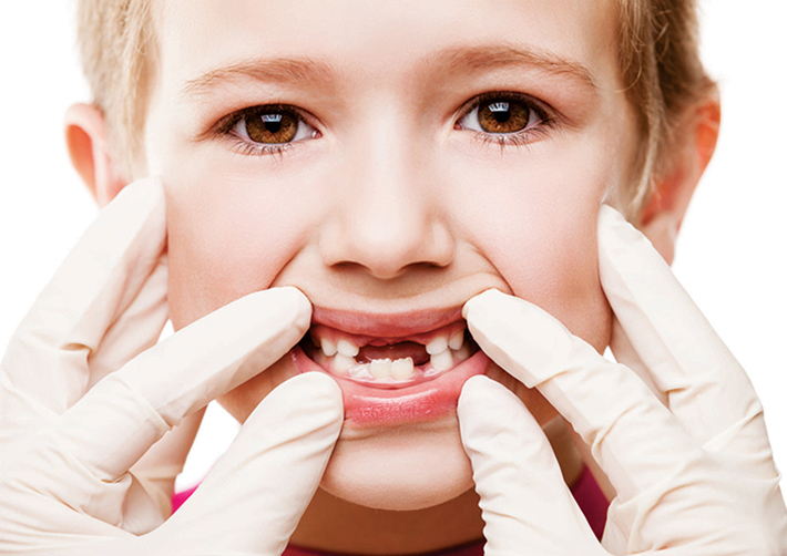 Ngăn ngừa sâu răng ở trẻ