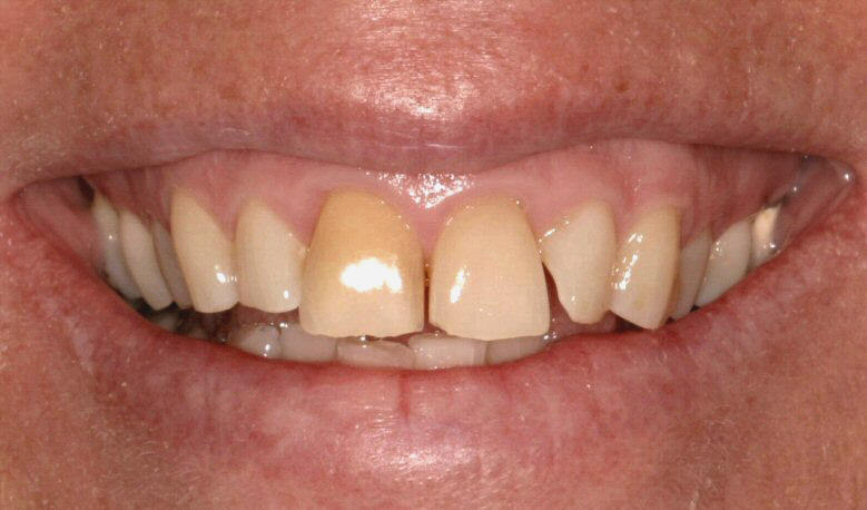 Điều trị răng nhiễm Tetracycline