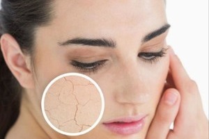 Cách chữa nẻ da tại nhà đơn giản cho bạn