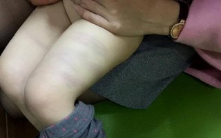 Thanh Hóa: Tâm sự của cô giáo mầm non đánh trẻ thâm tím 2 đùi 