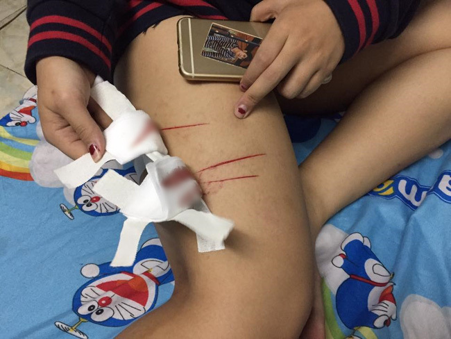 Nữ sinh bị rạch đùi ở Sài Gòn 3