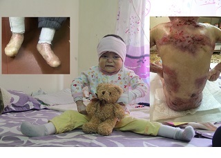 Lời kêu cứu của bé gái mắc bệnh quái ác, không có ngón chân ngày đêm đau đớn vì toàn thân bật máu