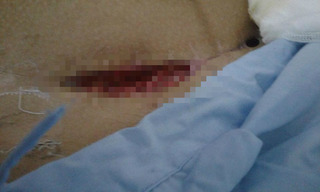 Thanh Hóa: Sản phụ mổ đẻ từ Tết khâu 2 lần vẫn bị bục chỉ và nhiễm trùng