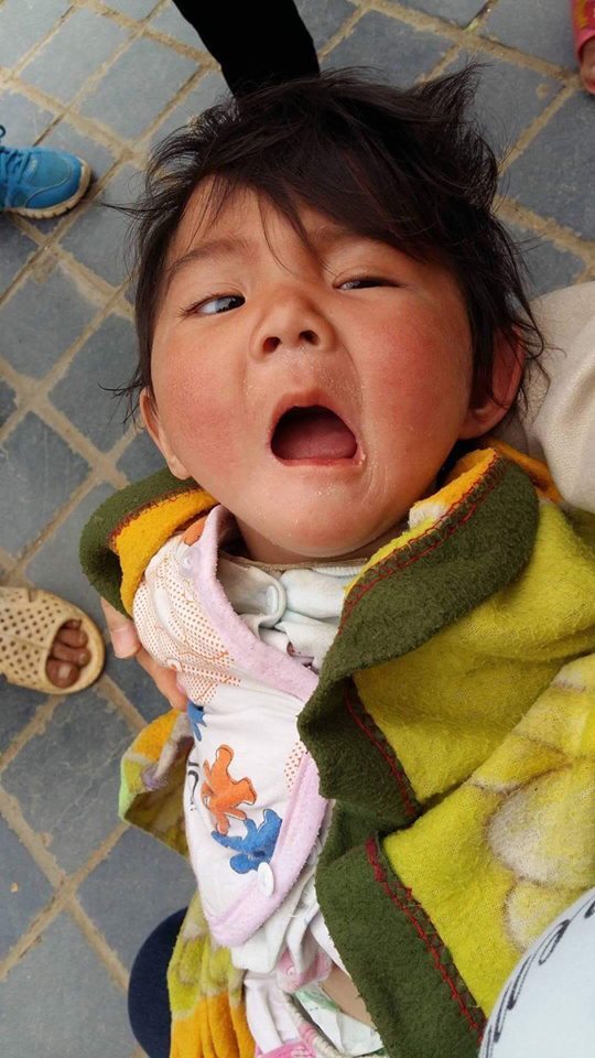 bé gái Lào Cai bị suy dinh dưỡng 12