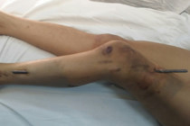Kinh hoàng cảnh nữ sinh bị que sắt nhọn 20cm xuyên thấu chân