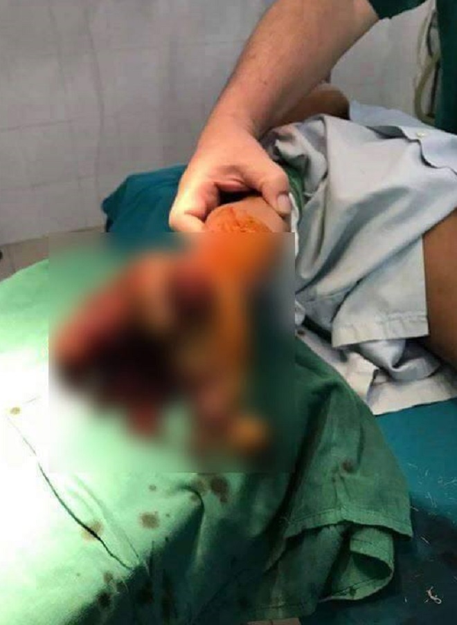 Bé trai 8 tuổi bị dập nát bàn tay 2